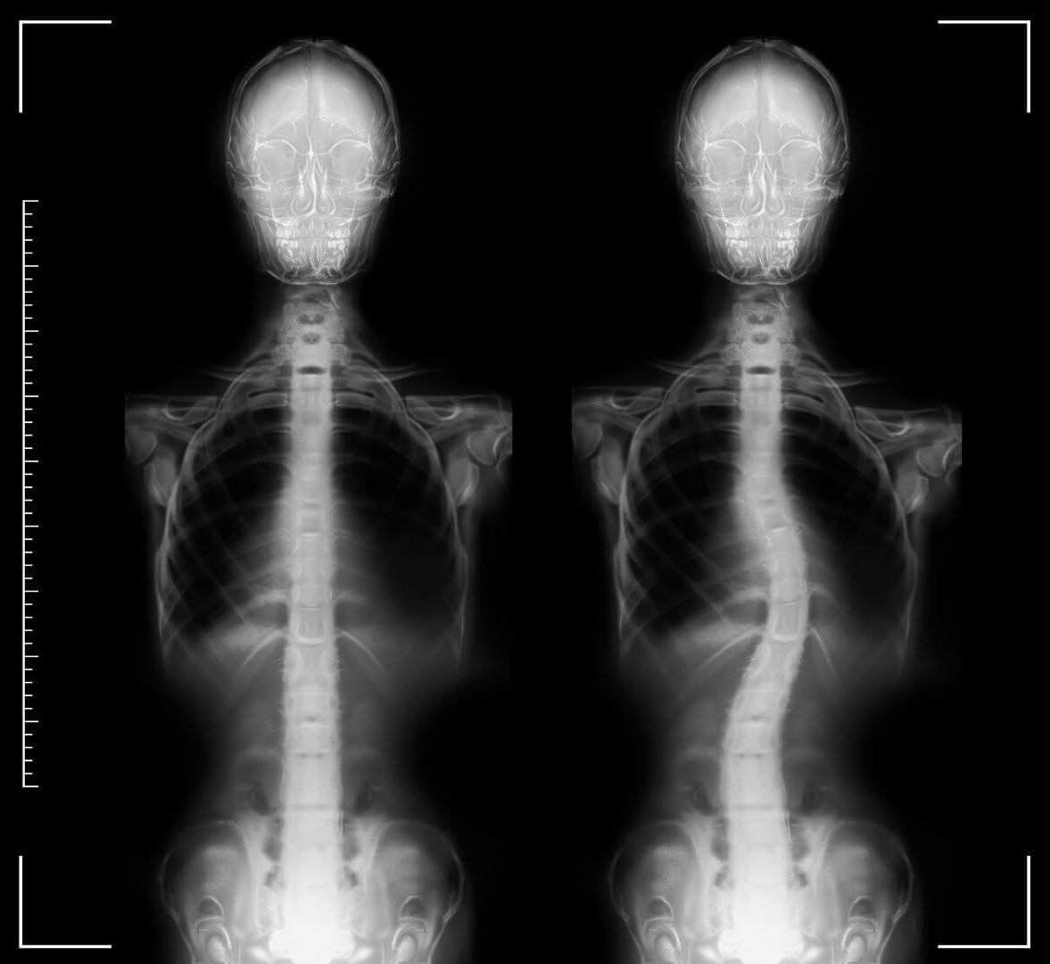 Illustrazione della differenza tra protrusione ed ernia del disco nella colonna vertebrale